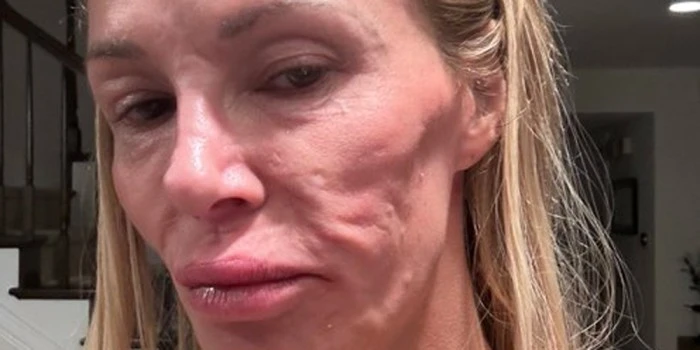 Brandi Glanville Says Shes Trying Cure Herself of Face Parasites